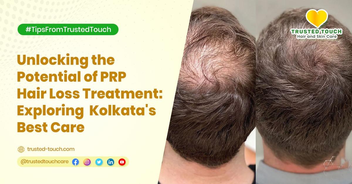 Unlocking the Potential of PRP Hair Loss Treatment: Exploring Kolkata’s Best Care
