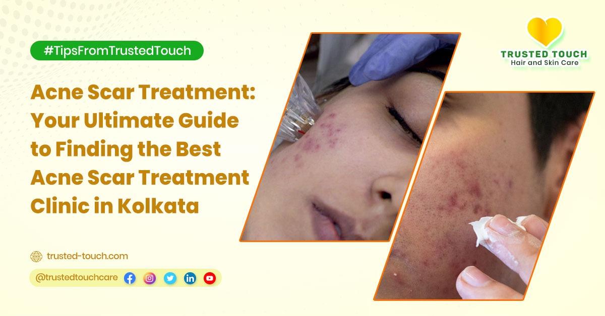 Acne Scar Treatment: Your Ultimate Guide to Finding the Best Acne Scar Treatment Clinic in Kolkata